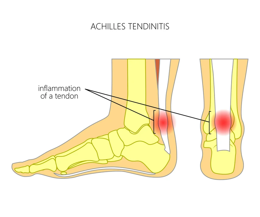 Tendonitis graphic